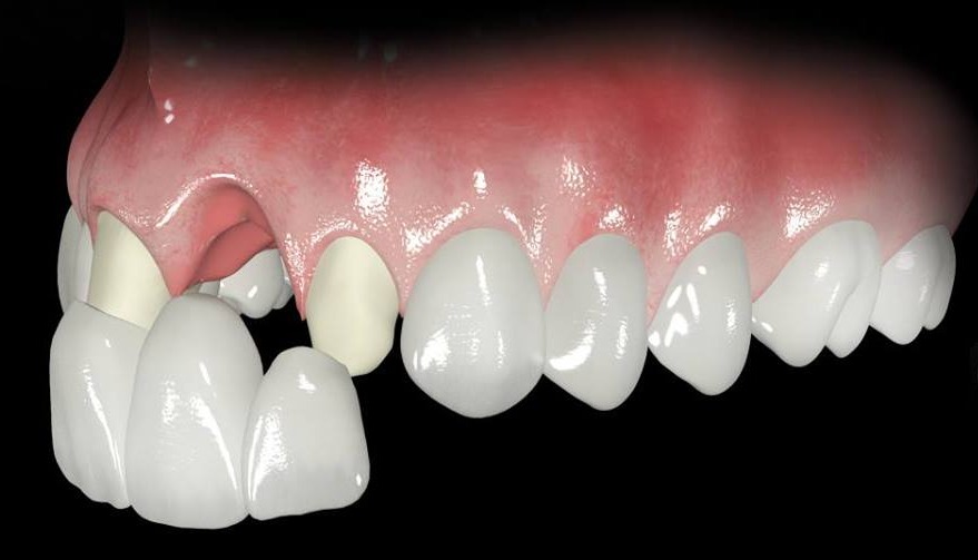 Replacement possibilities for multiple missing Anterior teeth